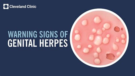 simptome herpes genital|Herpes Genitalis: Diagnosis, Treatment and Prevention